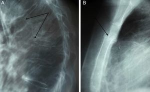 (A) Severe stage 3 dorsal vertebral fractures (arrows), moderate stage 1–2 dorsal fracture. (B) Fracture of the upper sternal body.