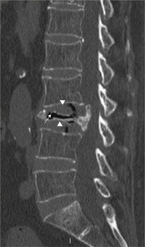 Sagittal CT reconstruction that shows the almost complete collapse of the L3 vertebral body with posterior displacement of the wall and spinal canal stenosis, with intravertebral vacuum (white arrow). Objective sign also show a vacuum at L2–L3 and L3–L4 (arrowheads).