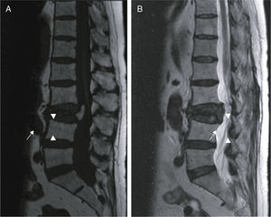 MRI sagittal T1 (A) and T2 (B) sequence showing the image of signal void in both, with secondary intravertebral air. There are signs of infiltration of the bone marrow and soft-tissue involvement.