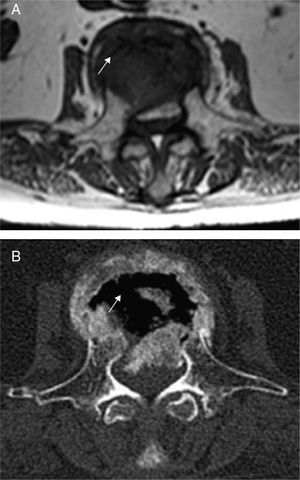 Axial MRI images (T1 sequence) (A) and CT imaging (B) in which the image shows linear low signal intensity on MRI corresponding to intravertebral ‘croissant-shaped’ air on CT (white arrows).