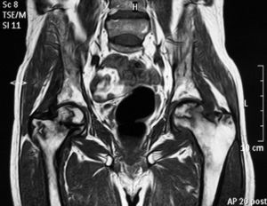 MRI of the hips. On T1-weighted images there are hyperintense areas seen surrounded by a hypointense halo affecting both femoral necks and heads, corresponding to extensive bone infarcts at that level.