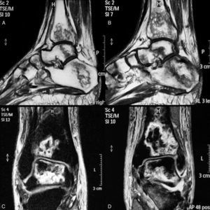 MRI of the ankles and tarsi. In the longitudinal sections of the T1 sequence there are extensive bone infarcts affecting the distal tibia, calcaneus, talus and foot elements, both on the right (A) or left side (B). In coronal sections, the STIR sequence also shows extensive infarcts of the distal region of the tibia and talus, more on the left than the right (D and C, respectively) and joint interline efussion.
