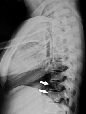 Lateral radiograph of the spine showing the “bone within a bone” sign, more evident in the lower vertebral bodies (white arrows).