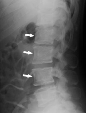 Lateral radiograph of lumbar spine showing similar findings to those of the thoracic spine (white arrows).