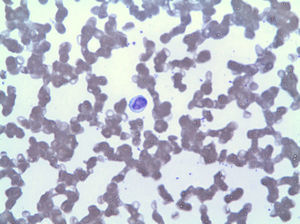 Lymphocytosis due to LGL.
