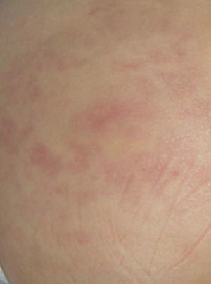 Erythematous, raised lesions on the buttocks (factitious panniculitis).