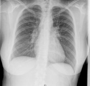X-ray: bilateral hilar lymphadenopathy.