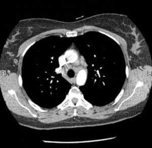 Chest CT: hilar and mediastinal lymphadenopathy (grade 1 sarcoidosis).