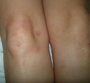 Painful erythematous nodules on the legs (erythema nodosum).