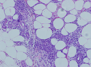 Factitious panniculitis: histiocytes with intracytoplasmic lipid vacuoles.