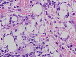 Erythema nodosum: granulomas in adipose tissue without necrosis.