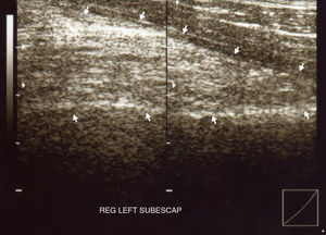 Ultrasound image in which there is a solid mass with alternating hypo- and hyperechoic areas below the serratus anterior muscle (arrows).