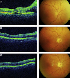 Optical coherence (left) and retinal tomography (right) of the patient