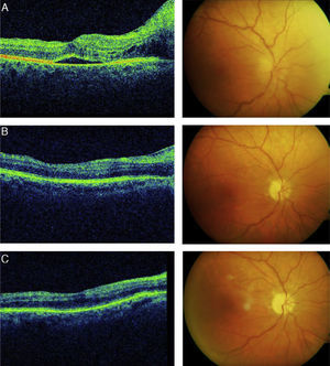Optical coherence (left) and retinal tomography (right) of the patient's right eye at 7 months after treatment with infliximab (A) and 2 (B) and 4 (C) months after switching anti-TNF -α treatment to adalimumab.