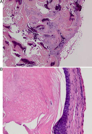(A) A well-defined, non-encapsulated tumor of the hair matrix. Cell proliferation in the lobes distinguished aspect formed by basaloid cells, keratinization and dystrophic calcifications (hematoxylin–eosin). (B) Under more detail we observed basophilic epithelioid cell proliferation suffering abrupt keratinization and presence of eosinophilic bodies called ghost cells (hematoxylin–eosin).