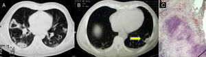 (A) Multiple bilateral nodules on chest CT, some cavitated, with areas of consolidation. (B) Sign of the air crescent (arrow). (C) Non casseus granuloma in the lung biopsy.