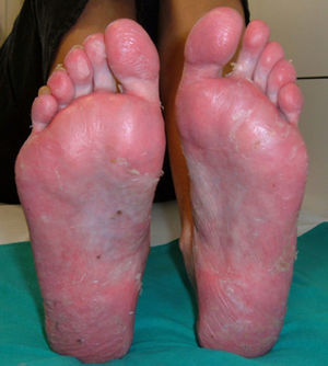 Plantar pustulosis with nail affection in a patient with fistulizing Crohn
