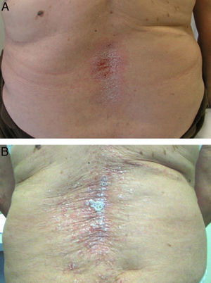 Patient with psoriatic arthritis who developed exacerbation of the psoriatic lesions 11 months after starting etanercept. (A) Improvement of the lesions 6 weeks after discontinuation of etanercept. (B) Recurrence of the lesions 6 weeks after restarting etanercept.