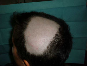 Patient with HLA-B27 positive ankylosing spondylitis who developed progressive alopecia areata after the start of anti-TNF therapy, extended to the middle of the scalp 15 days after the fourth infusion of infliximab.