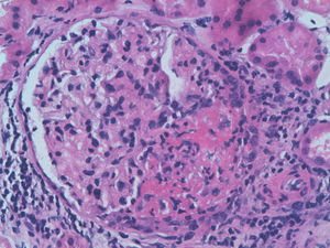 Hematoxylin and eosin (×40) showing a circumferential crescent.