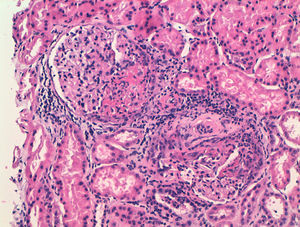 Hematoxylin and eosin (×20) with fibrinoid arteriole necrosis.