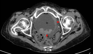 Bladder tumor.