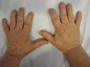 Hands. Diffuse thickening of soft tissues. Swan neck deformity of the third fingers, bilaterally, with increased interphalangeal creases.