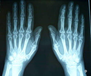 Simple X-rays of hands. Soft tissue augmentation. Diffuse periostitis.