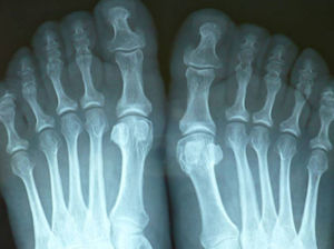Feet X-ray. Increased joint space due to hypertrophy of the cartilage. Bony proliferation.