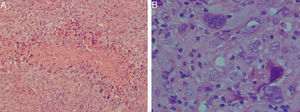 Epithelioid sarcoma. (A) Necrosis surrounded by mononuclear epithelioid cells forming a diffuse, dense stroma (H–E, 10×). (B) Monomorphic cells with a vesicular nucleus prominent nucleolus and a high mitotic rate. Some areas have intensely atypical and multinucleated forms (H–E, 40×).