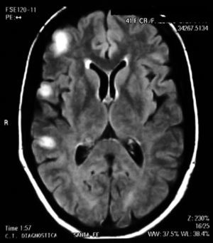 Central nervous system MR showing hyperintense lesions in T2 on the frontal, temporal and parietal right regions.
