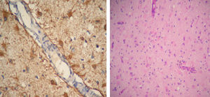 Diffuse astrogliosis of the cerebral cortex and GFAP+, CD68+ reactive astrocytes (Luxol Fast blue–hematoxylin–eosin).