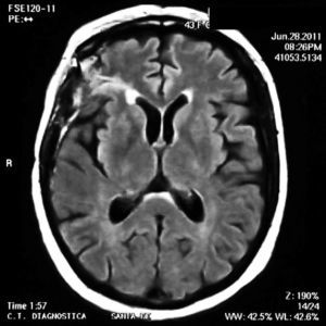 Central nervous system MR after treatment with intravenous cyclophosphamide without evident lesions.