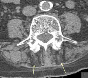 Axial L4 CT. Selective atrophy of the posterior paravertebral musculature and fat degeneration/substitution (yellow arrows).