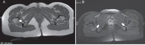(A) Axial T1: impingement of the ischiofemoral spaces (thick arrow) and quadratus femoris (asterisk). (B) Axial T2 fat suppression signal: edema in both femoral muscles.