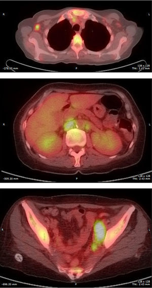 PET SCAN showing hypermetabolic axillary, abdominal and pelvic polyadenopathy.