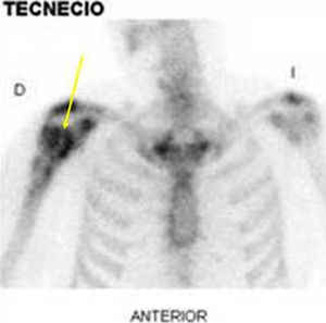 Scintigraphic uptake in the right proximal humerus.