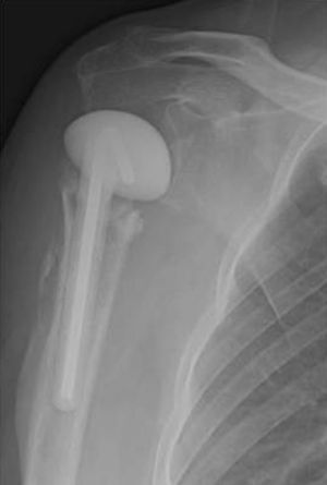 Image of the spacer positioned and centered in height relative to the glenoid.