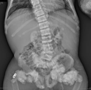 Bilateral nephrocalcinosis, vertebral osteoscleorosis (rugby jersey spine), osteosclerosis in Paget-like pelvic bones. Osteomalacia. Nodular calcifications. Bilateral subtrochanteric fracture. Surgical material at the proximal end of the right femur.