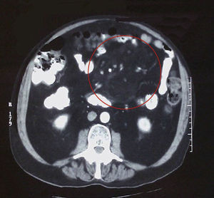 CT scan of the abdomen and pelvis: marked thickening of mesenteric fat and displacement of the small intestine.