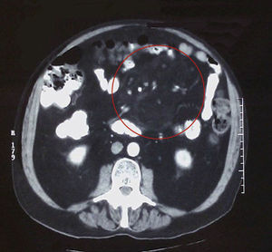 CT scan of the abdomen and pelvis: marked thickening of mesenteric fat and displacement of the small intestine.
