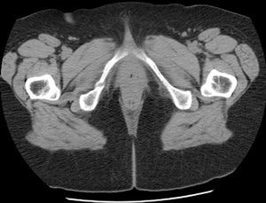 Bone scan: multiple bone involvement, with fixed tracer (99mTc-diphosphonates) found in bilateral ribs, a vertebral body, the horizontal branch of the pubis and right inferior pubic ramus.