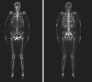 CT scan of pelvis showing multiple fractures in different stages of progression at the level of the right pubis and ischium bilaterally.
