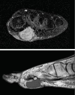 MRI of left foot: soft tissue solid tumor, poly-lobular, measuring 5.3cm×2.6cm×2cm in a subdermal location, inserted deep into the muscular plane, separated from the bone.