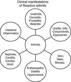 Clinical manifestations of reactive arthritis.