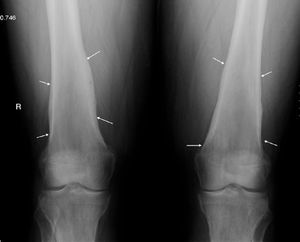 Periosteal thickening of both femurs.
