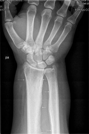 Ulna and radius affection.