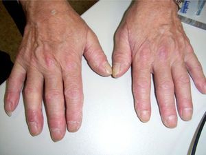 Mechanics hands: hyperkeratotic lesions and lateral cracks in the fingers and palm surfaces.