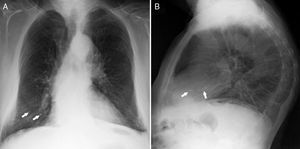 Posteroanterior chest X-ray (A) and lateral X-ray (B) with a radiopaque image on the trajectory of the pulmonary vessels (arrows) in the lower third of the right hemithorax, related to cement emboli at that level.