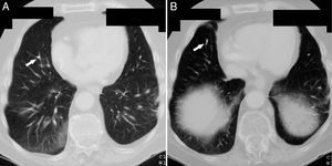 Chest CT scan showing cement emboli (arrows) in bifurcations (A) and distal branches (B) of the right pulmonary artery at the level of the lower lobe.
